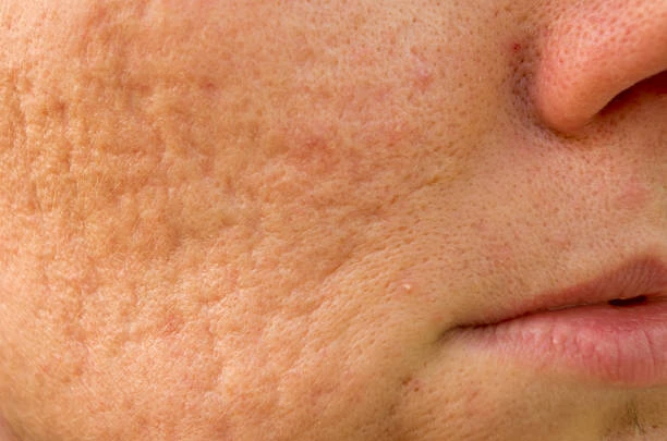 TREATING LARGE PORES (3)