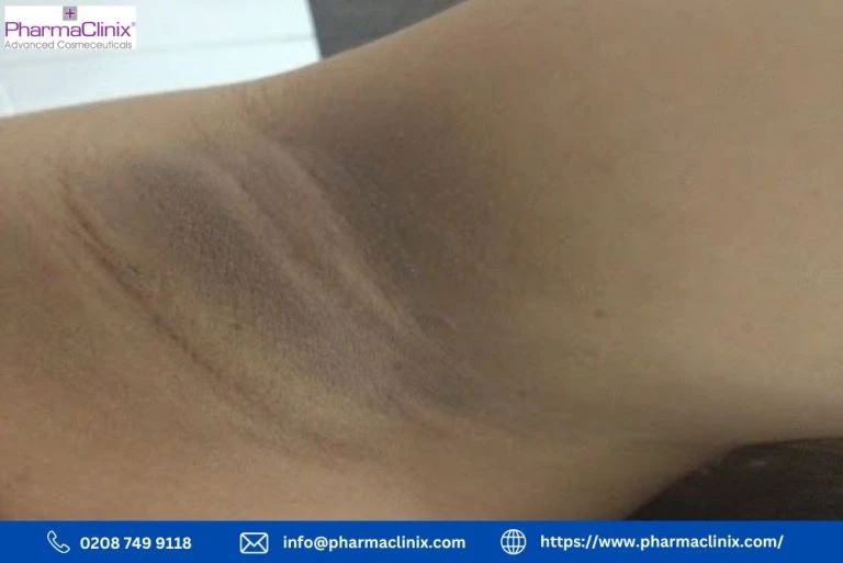 Get expert advice on addressing dark patches in your underarms and regain confidence in your skin. Say goodbye to insecurity and embrace brighter, smoother underarms today!