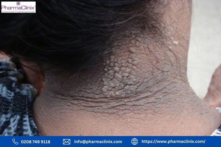 Discover the secrets behind dark patches on your neck. Learn about causes, effective treatments, and prevention strategies to reclaim smooth, even-toned skin.