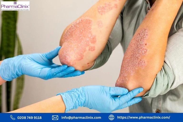 Eczema doesn\'t discriminate based on skin color, but its impact may vary. Learn how to recognize eczema in darker skin tones and access expert advice on achieving long-term relief and confidence.