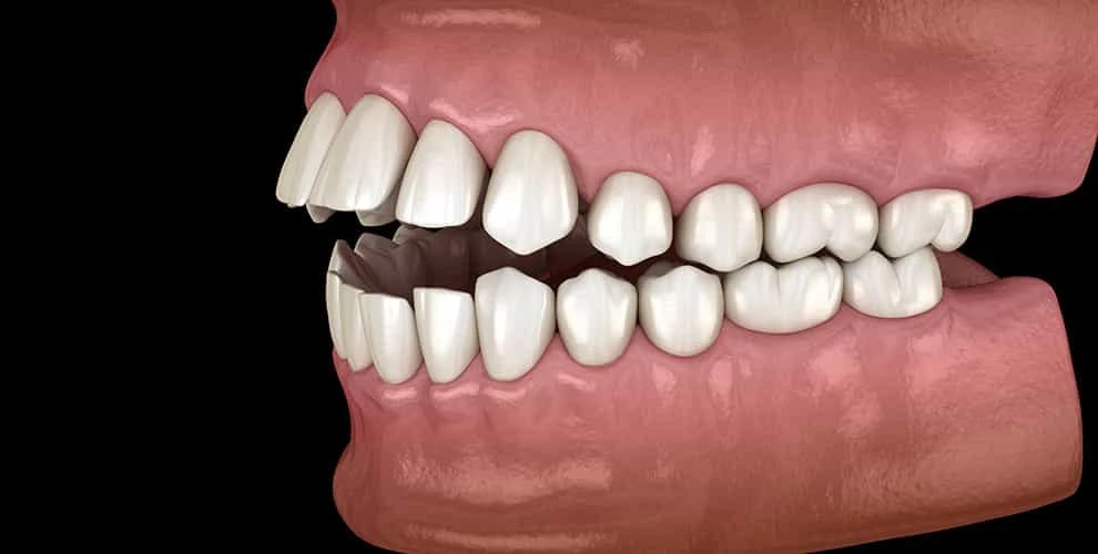 Corrective Jaw Surgery in Delhi