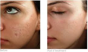 Platelet Rich Plasma (PRP) Rejuvenation Treatments - Aesthetic Medical Center