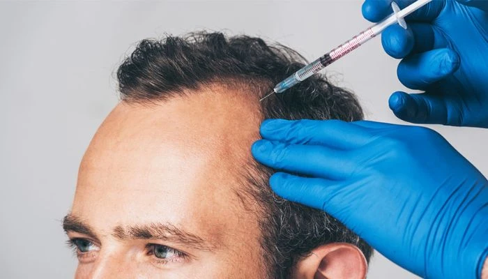 Why PRP is the Best Choice for Hair Restoration