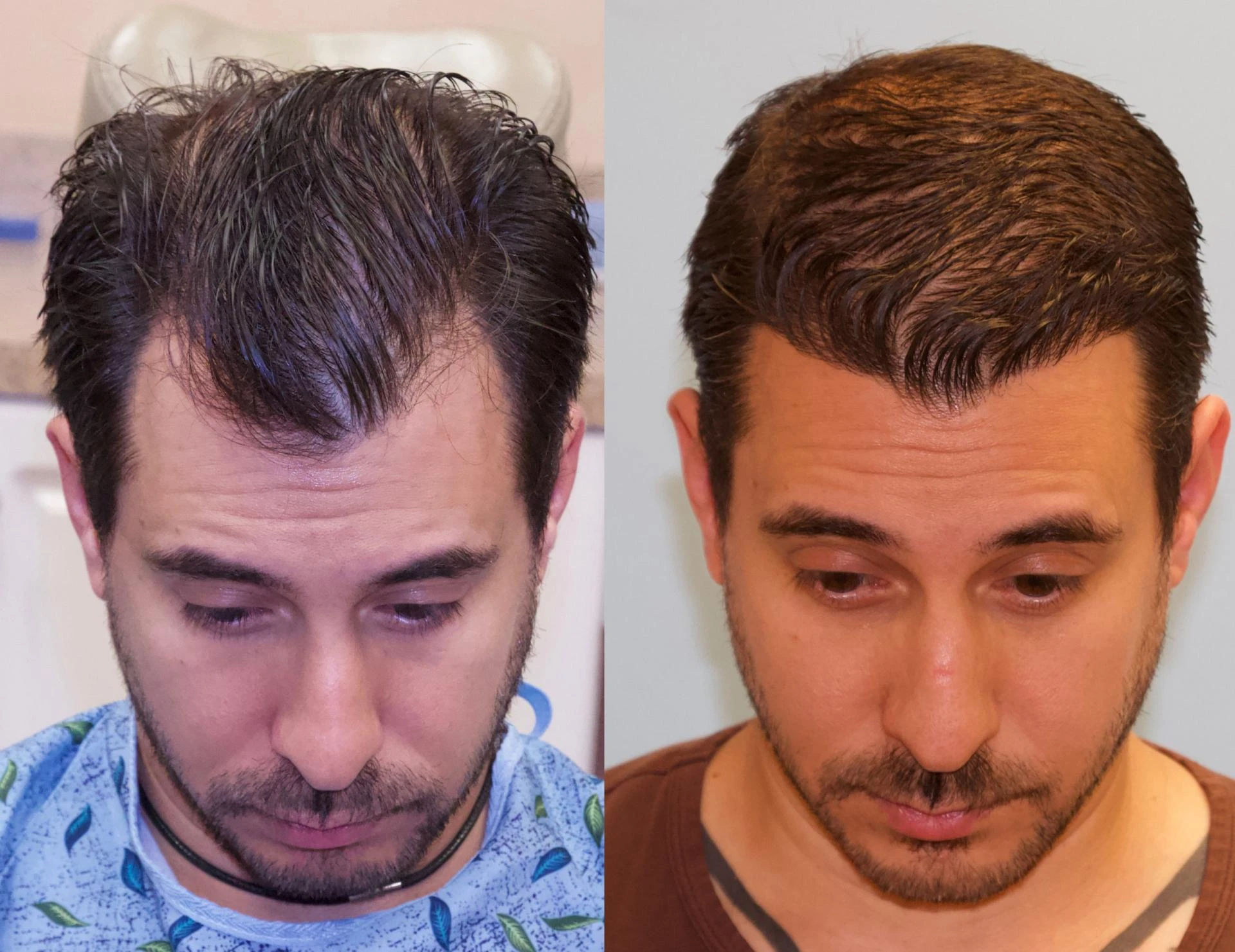 1500 Graft Hairline Restoration - Carolina Hair Surgery