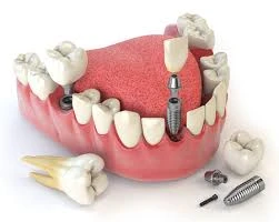 Dental Implants in Guntur | Full Mouth ...