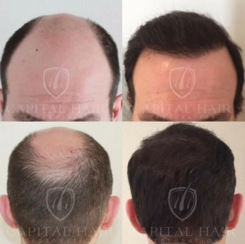 Why Hair Transplant Costs Differ Across the UK