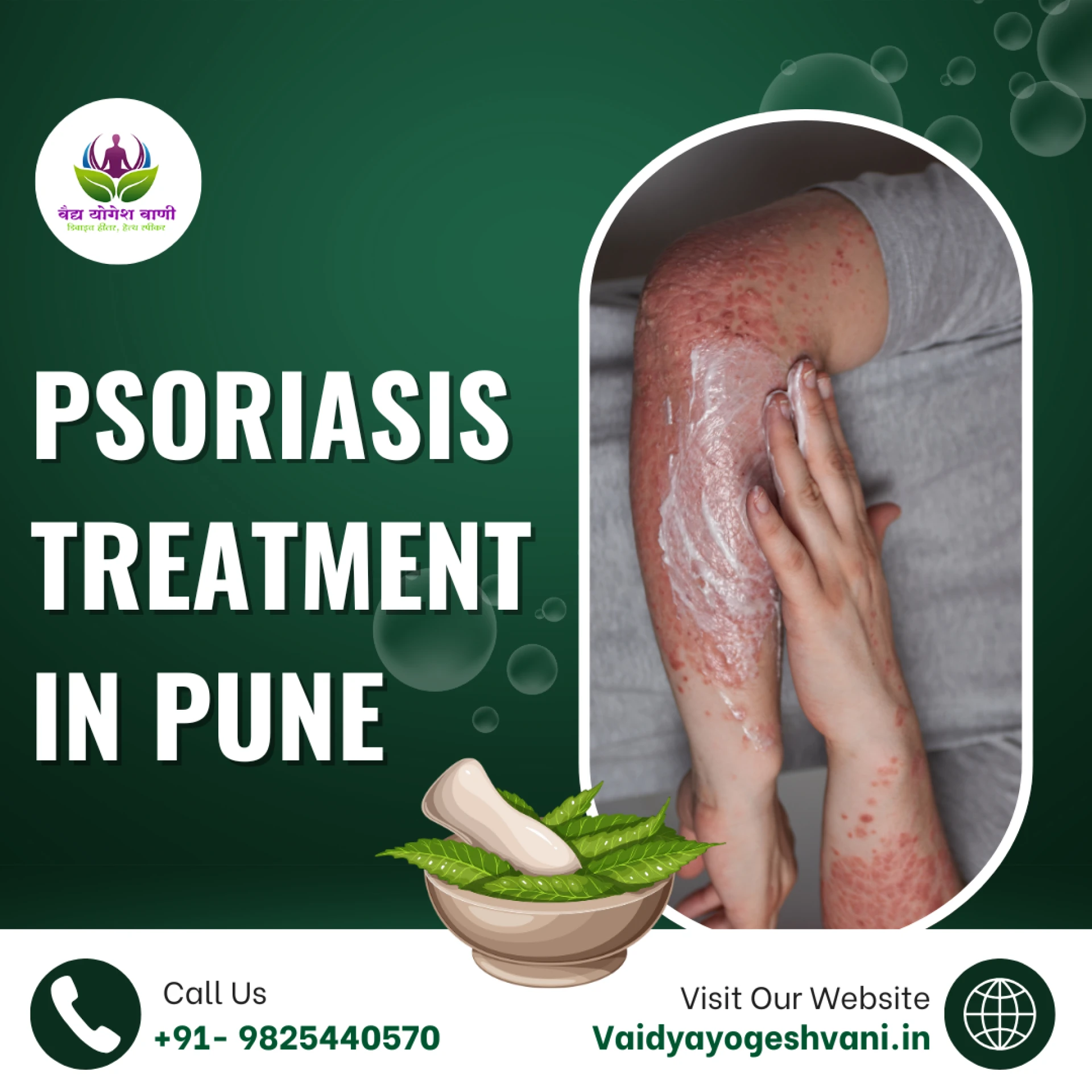 Vaidya Yogesh Vani: Holistic Psoriasis Treatment in Pune through Ayurvedic