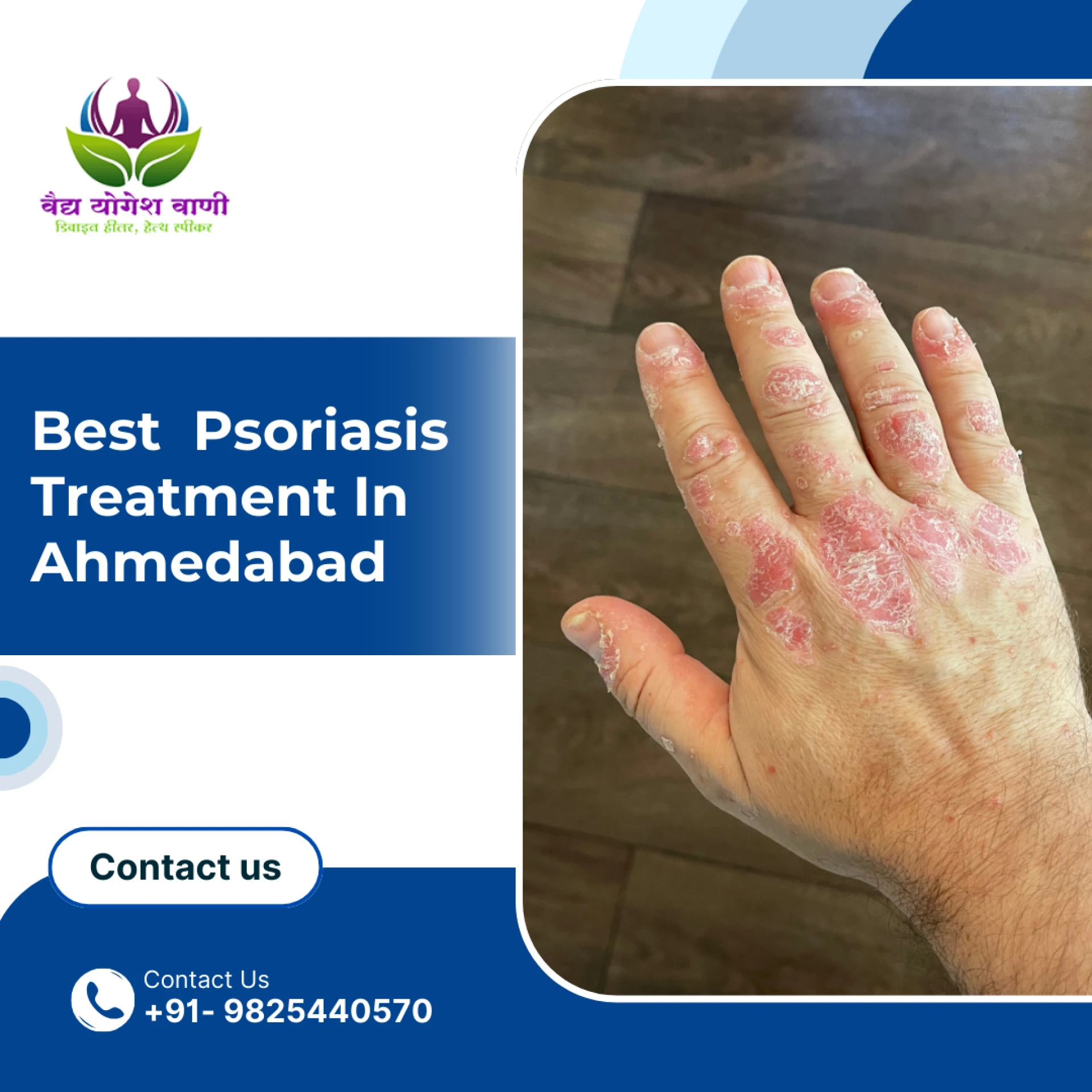 Best Psoriasis Treatment in Ahmedabad with Vaidya Yogesh Vani
