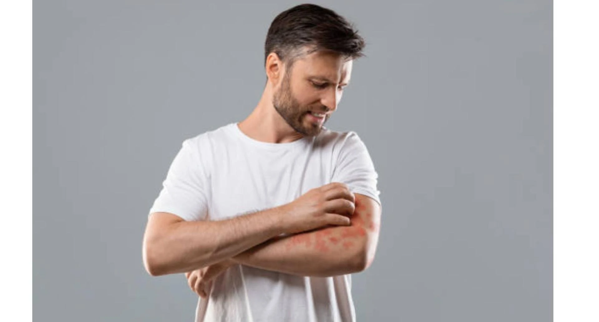 Managing Psoriasis Naturally: Homeopathy, Diet, and Scalp Care Tips