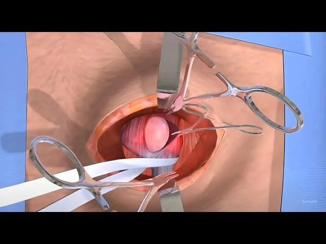 Expert Hernia Surgery in Riyadh: Trust Our Skilled Surgeons for Your Recovery