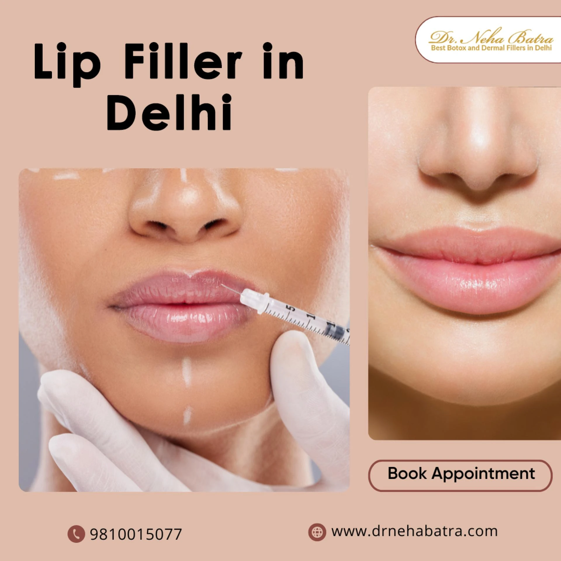 Lip Filler Treatment in Delhi: Enhance Your Beauty with Dr. Neha Batra