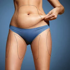 شفط الدهون في دبي: استثمار في صحتك وجمالك