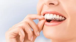 Invisalign Treatment- Five Signs Your Child Needs Them for Better Smile