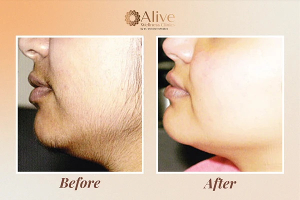 The Best Skin Treatment & Laser Hair Reduction in Delhi