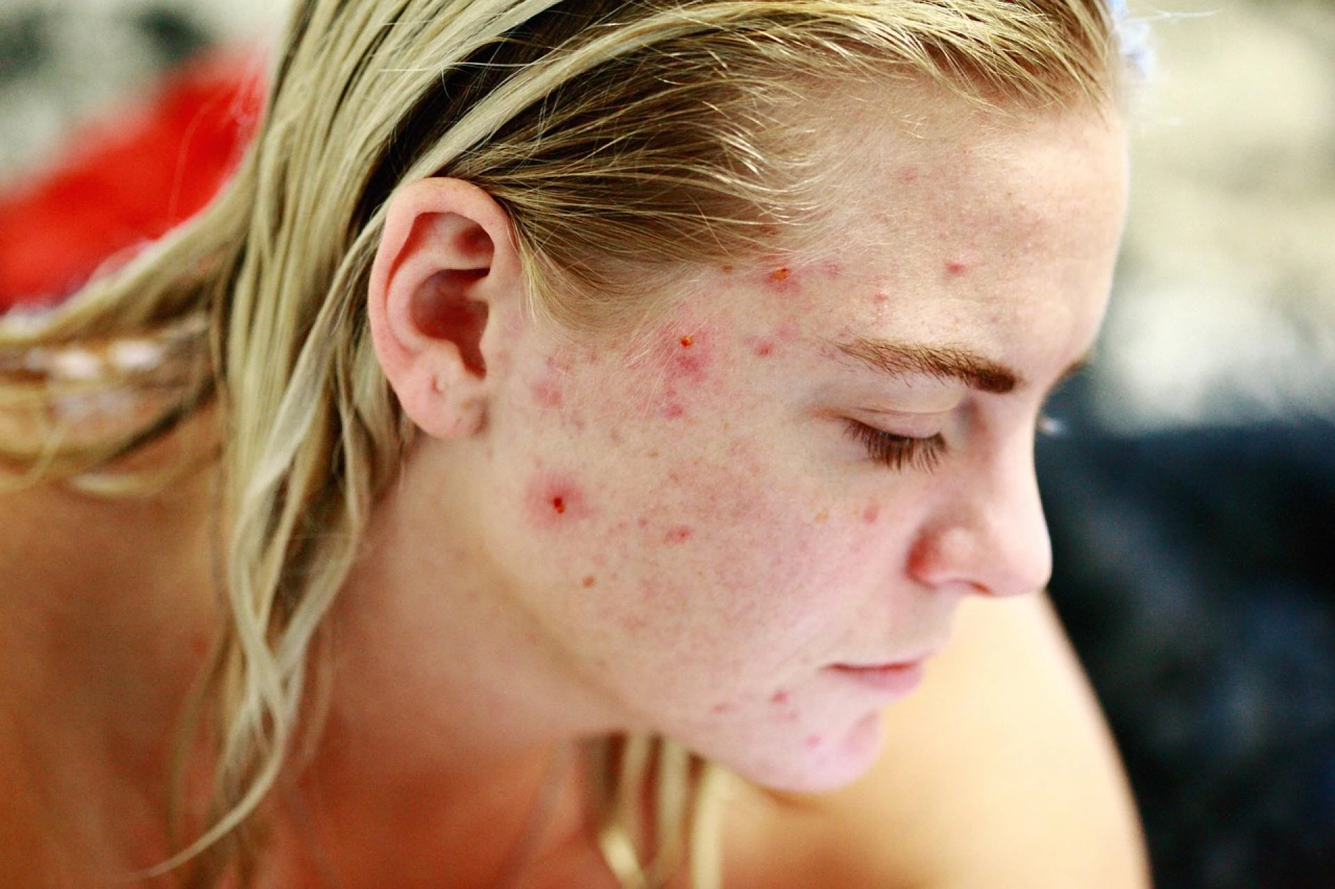 What are the Solutions for Stubborn Acne Scars?
