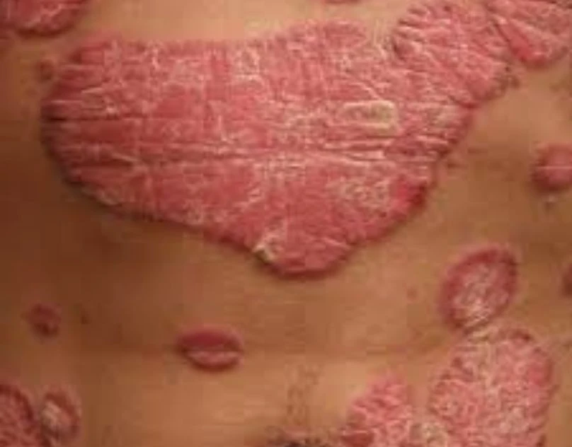 The Role of Skin Infection Antibiotics in Modern Skincare