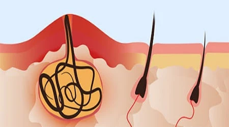 Treating Pilonidal Cyst