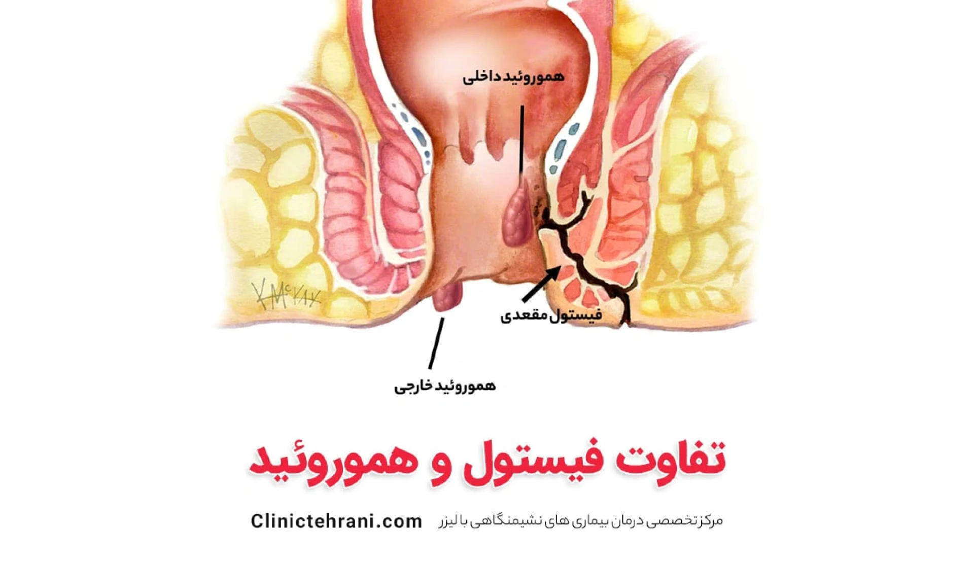 Fistula Treatments