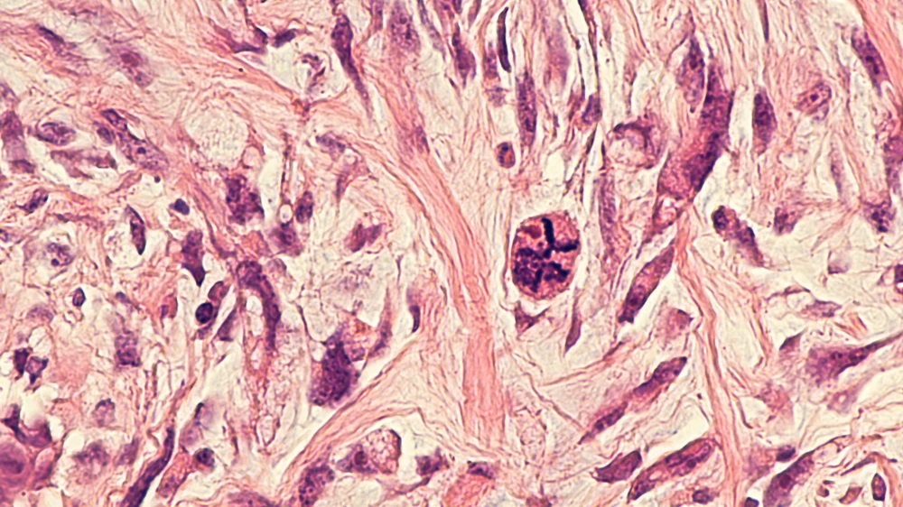Phyllodes Tumor Causes: Key Factors and Risk Considerations