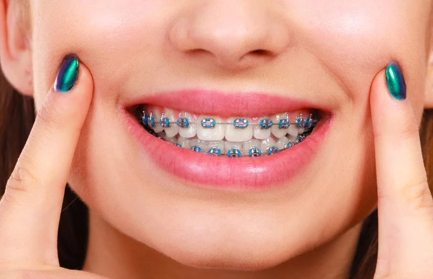 Caring for Your Braces: Tips for a Smooth Journey