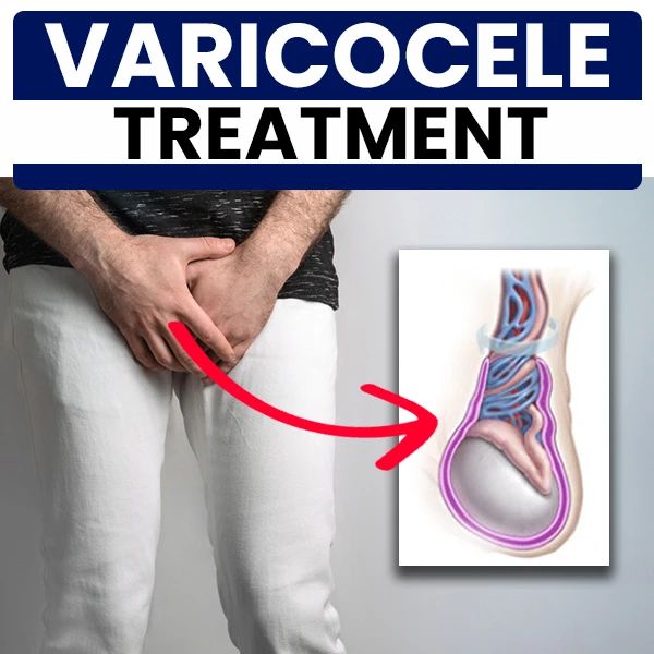 Best Varicocele Treatment Without Surgery: How Homeopathy Provides Natural Relief