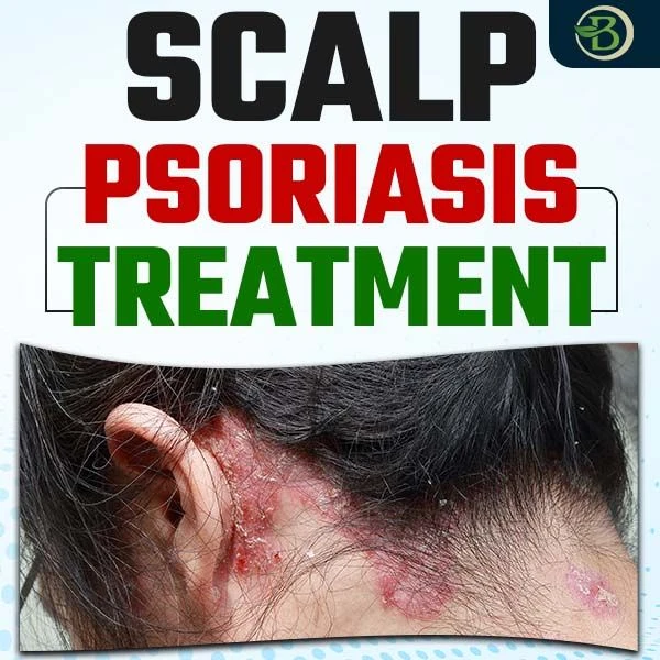 Natural Scalp Psoriasis Treatment: How Effective Is Homeopathy?