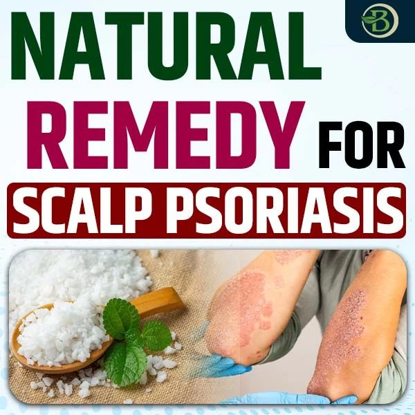 Natural Scalp Psoriasis Treatment: How Effective Is Homeopathy?