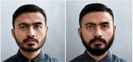 Best Beard Hair Transplant Clinic