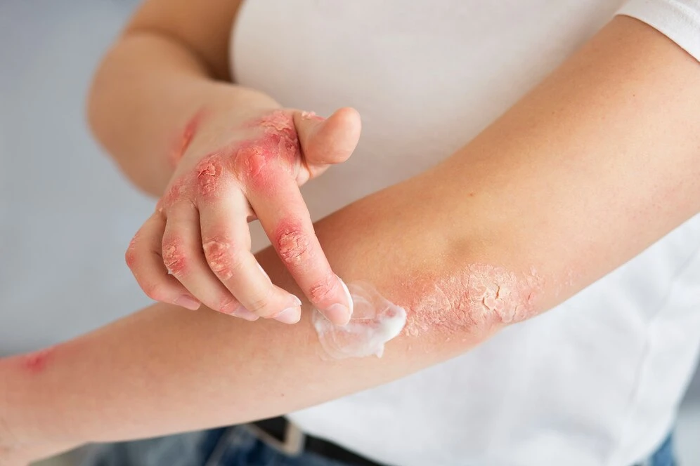 How does stress affect eczema, and what are some ways to manage it?