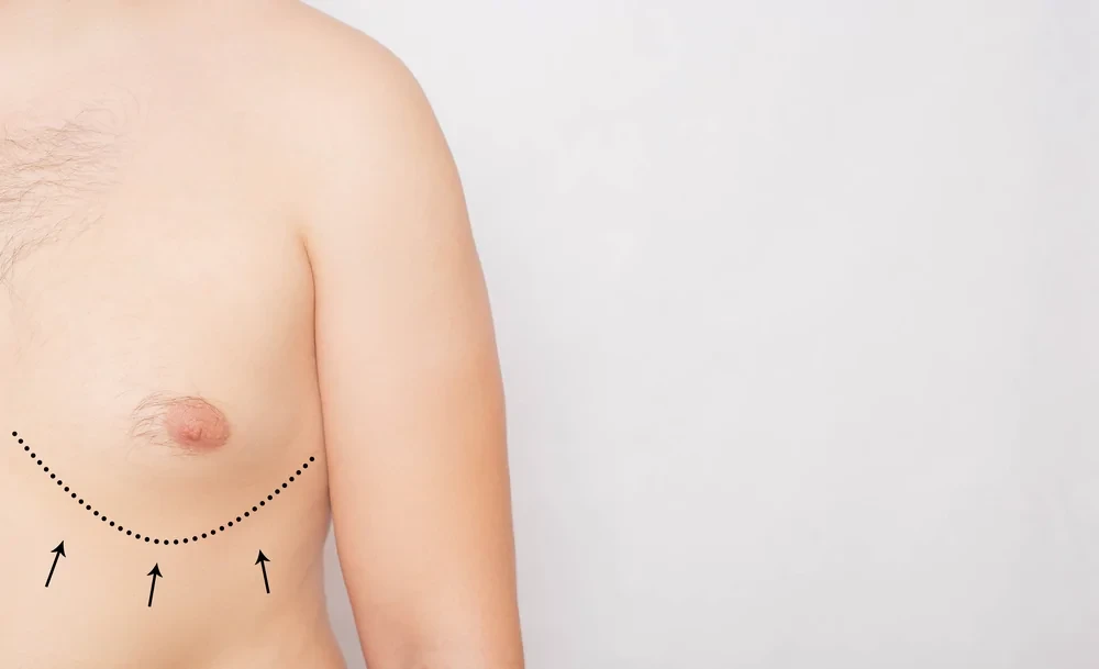 Male Chest Correction Surgery: Shape your Chest, Shape your Confidence