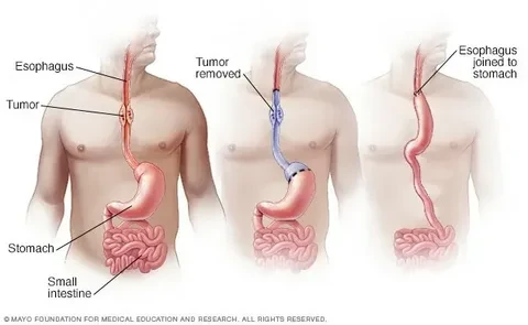 Best Esophageal Cancer Surgeons in Dubai – Expert Care for Your Health