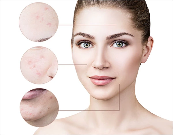 Effective Acne Treatment for Clear and Healthy Skin | Right Direction Advanced Cosmetics