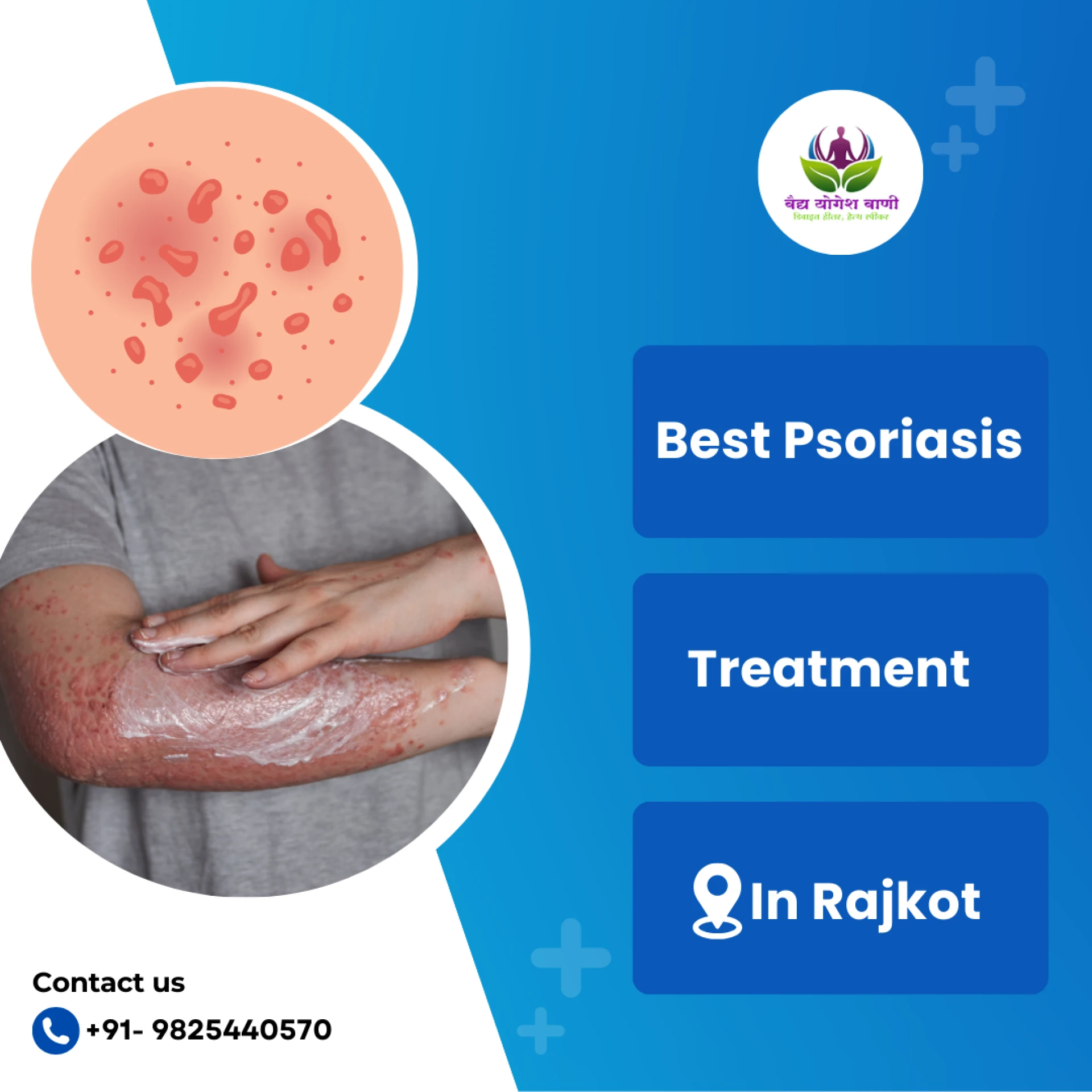 The Best Psoriasis Treatment in Rajkot: Find Relief with Vaidya Yogesh Vani