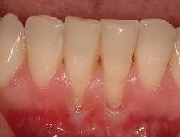 Expert Dental Cap Services for Function and Beauty in Merritt, BC!