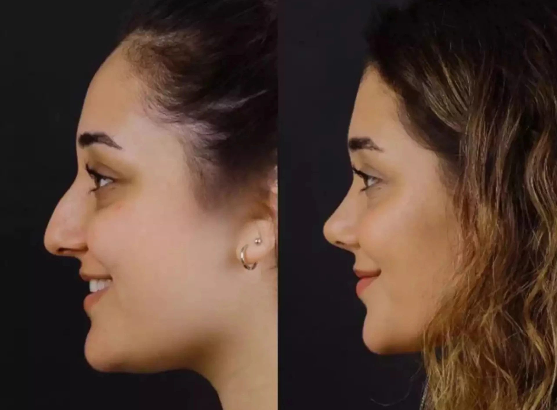 Can Septoplasty in Dubai Worsen Breathing Problems?