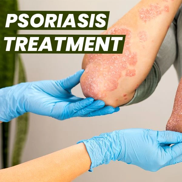 The Secret to Clear Skin: Natural Treatments for Psoriasis That Work
