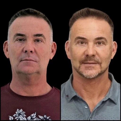 Radiate Confidence with Profhilo Treatments in Dubai