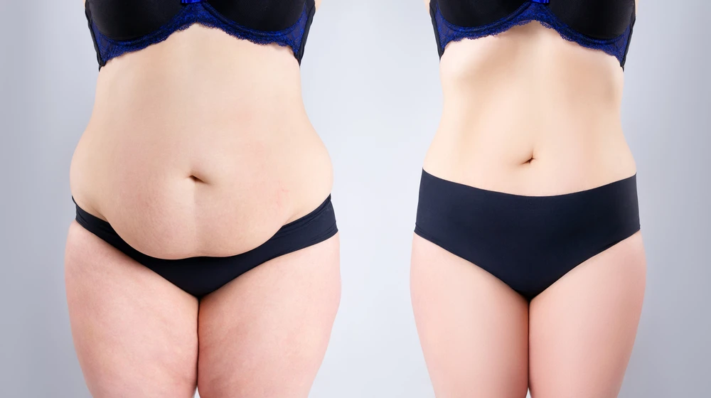 Where to Start When Considering a Tummy Tuck?
