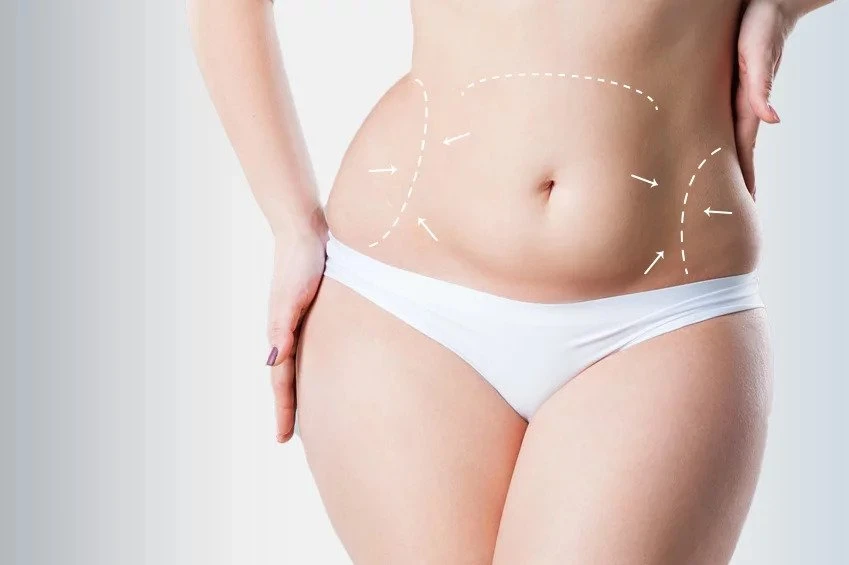 Where to Start When Considering a Tummy Tuck?