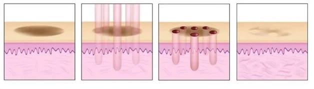 Fractional CO2 Treatment for Skin Rejuvenation
