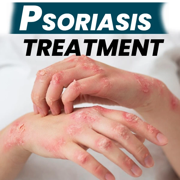 Homeopathic Remedies for Psoriasis: Can They Offer Lasting Relief?