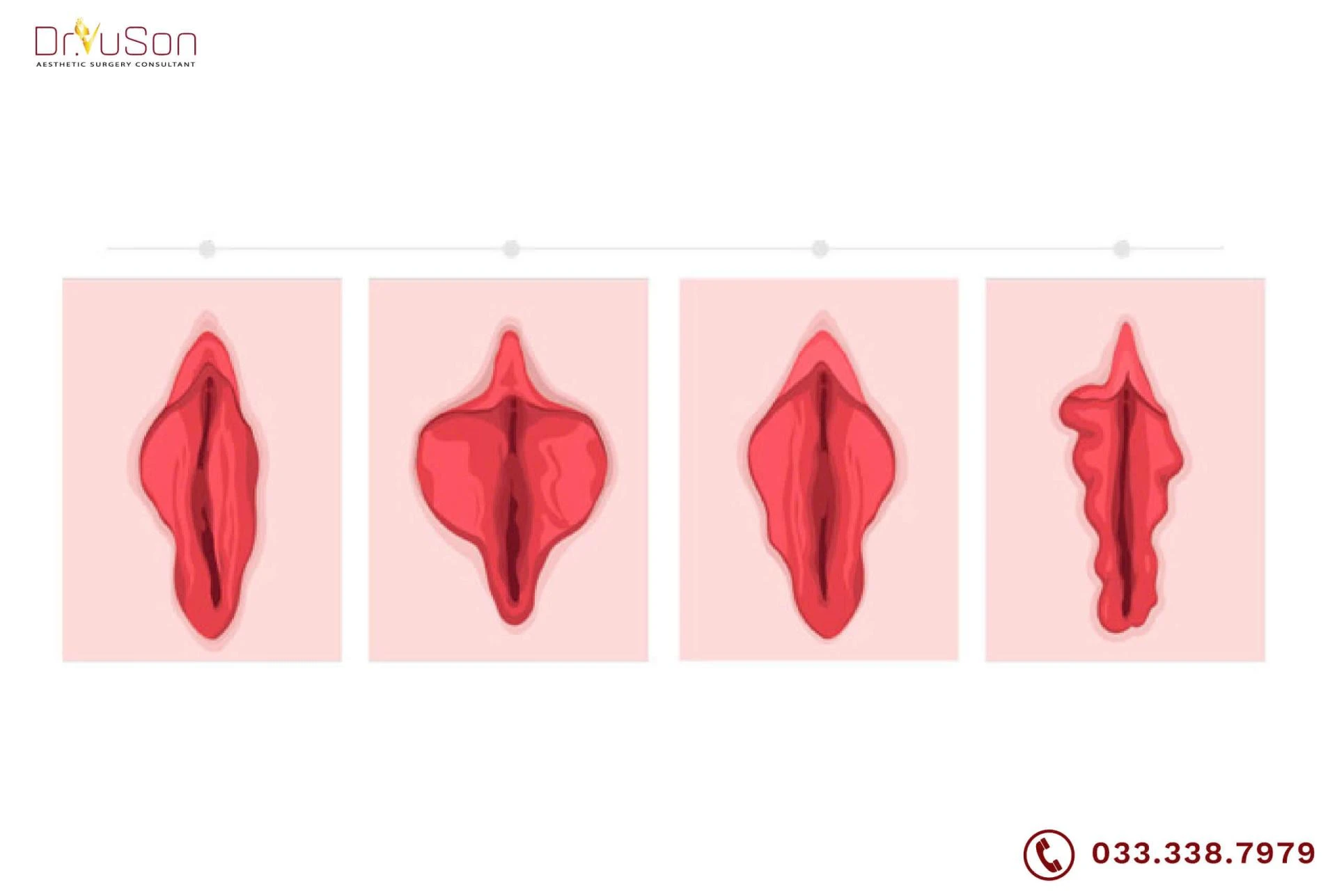 Cắt Môi Cô Bé Giá Bao Nhiêu? Góc Nhìn Của Giới Thượng Lưu Trước Khi Thực Hiện