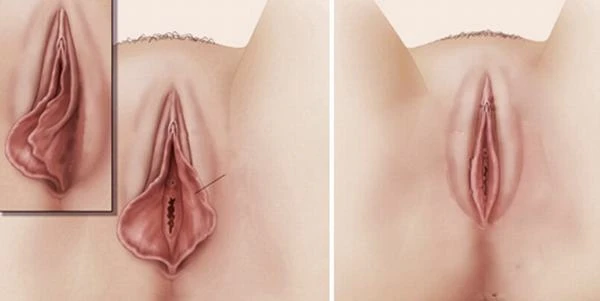 Cắt Môi Cô Bé Giá Bao Nhiêu? Góc Nhìn Của Giới Thượng Lưu Trước Khi Thực Hiện