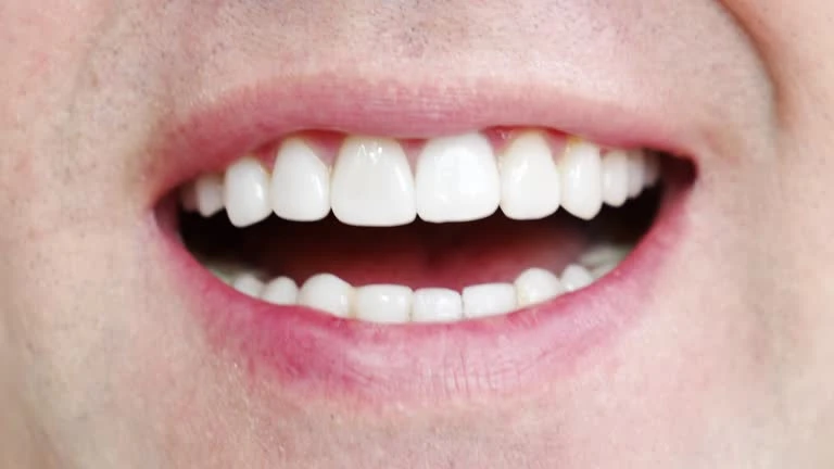 8 Essential Facts About Dental Crowns