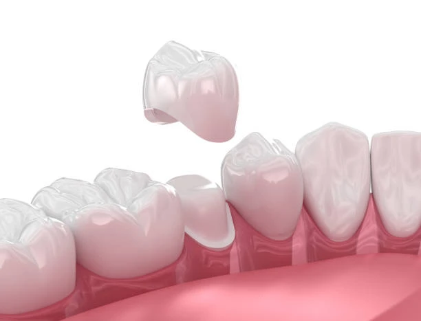 8 Essential Facts About Dental Crowns