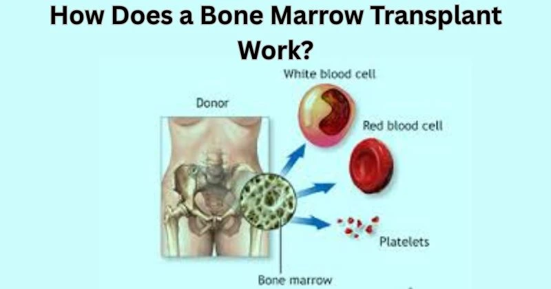How Does a Bone Marrow Transplant Work?
