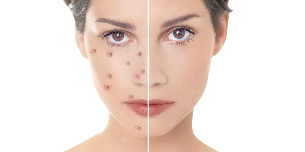 When to See a Dermatologist in Islamabad for Pimples: A Complete Guide