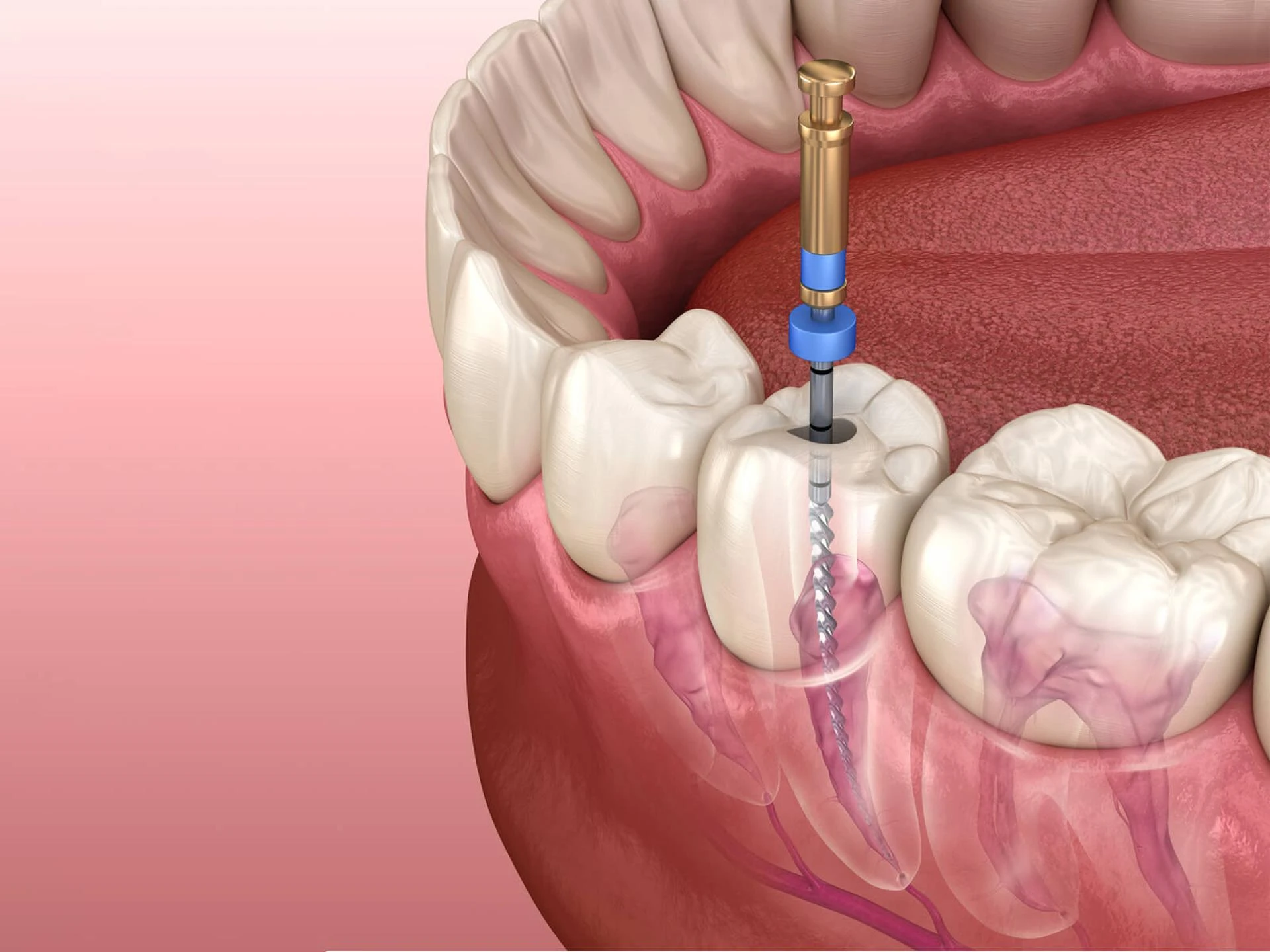 Fast and Effective Emergency Root Canal Services Near You