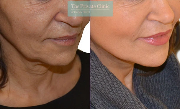Understanding the Mini Facelift Cost in London: Factors and Considerations