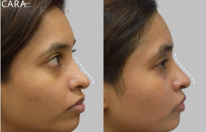 Everything You Need to Know About Non-Surgical Rhinoplasty